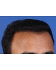 After Hair Transplant&nbsp;Front